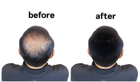 The Ultimate Guide to Applying and Maintaining a Hair Patch.