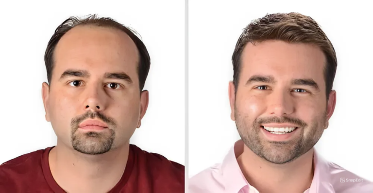 Best Hair Patch Service in South Delhi.