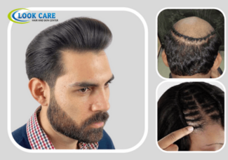 best hair patch service in Delhi.