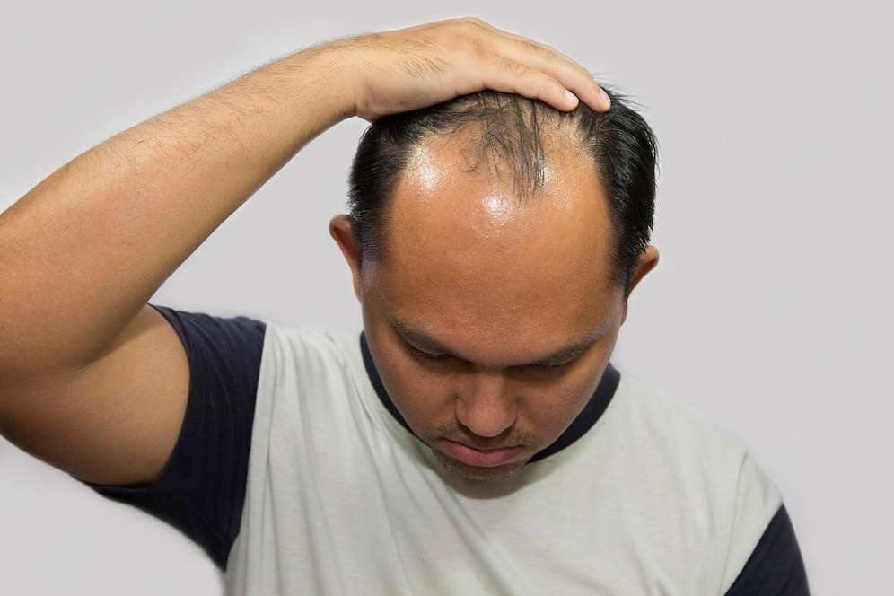 Best Hair Patch in Lajpat Nagar, Delhi