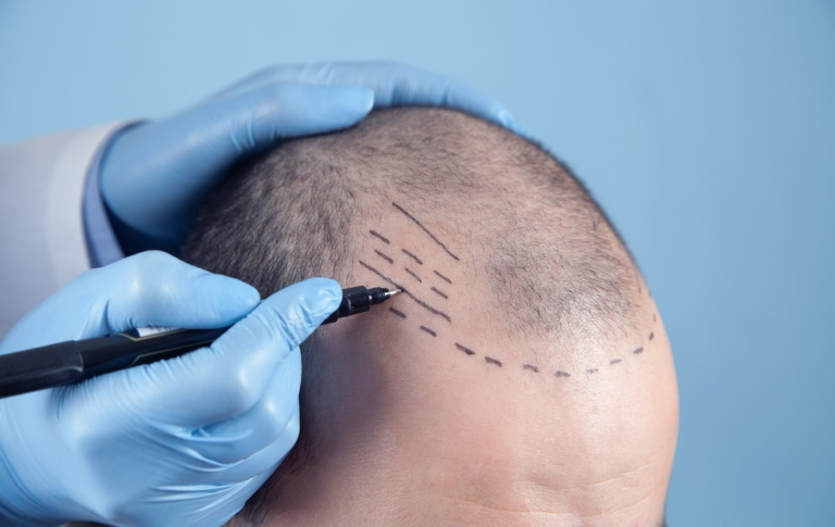 Best Non surgery hair replacement in Lajpat Nagar