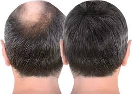 Hair Replacement